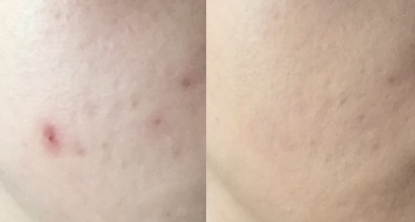 twarz przed i po zastosowaniu podkładu w kompakcie Avene twarz przed i po zastosowaniu podkładu w kompakcie Avene