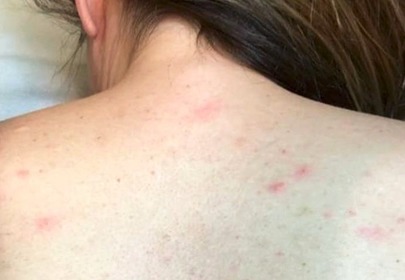 dziewczyna z trądzikiem na plecach dziewczyna z trądzikiem na plecach