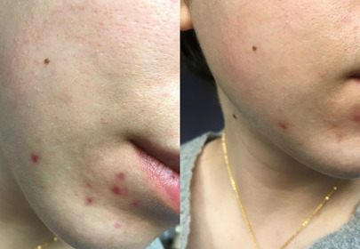 Zdjęcia z testowania żelu MediqSkin Plus, efekt przed i po Zdjęcia z testowania żelu MediqSkin Plus, efekt przed i po