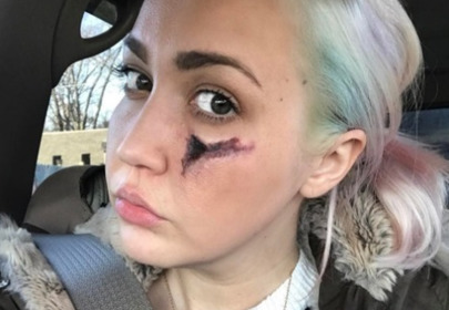 dziewczyna z raną na policzku po ukąszeniu pająka dziewczyna z raną na policzku po ukąszeniu pająka