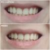 Zdjęcie do recenzji Faworyt w kwestii wybielania zębów (również dla nadwrażliwych) od użytkownika bast3t
