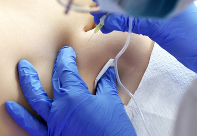 karboskryterapia karboskryterapia