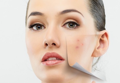 peeling chemiczny peeling chemiczny